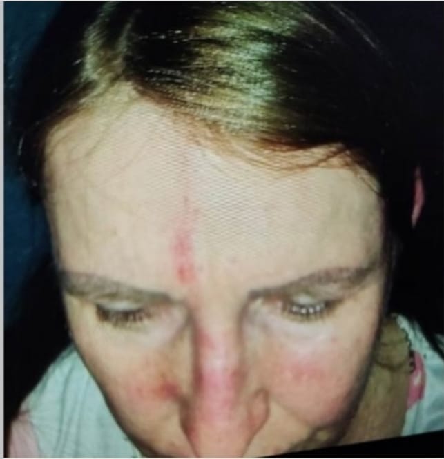 Hematomas no rosto da empresária, após agressão. (Foto: reprodução)